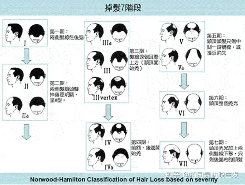 你有没有脱发的困扰呢