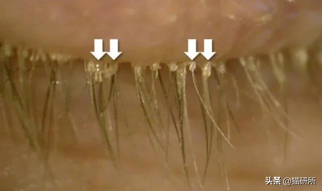 女子眼睛红肿、视力下降，竟被查出睑板腺功能障碍，医生：假睫毛惹的祸